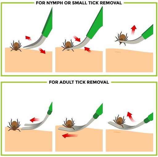 TickCheck Premium Dog Tick Removal Kit
